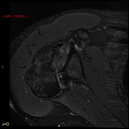 Figure 2 for case Chronic posterior glenohumeral dislocation ( RID4770 )